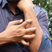 Studio Novartis, l’orticaria cronica spontanea costa 4.200 euro l’anno a paziente Studio Novartis, l’orticaria cronica spontanea costa 4.200 euro l’anno a paziente