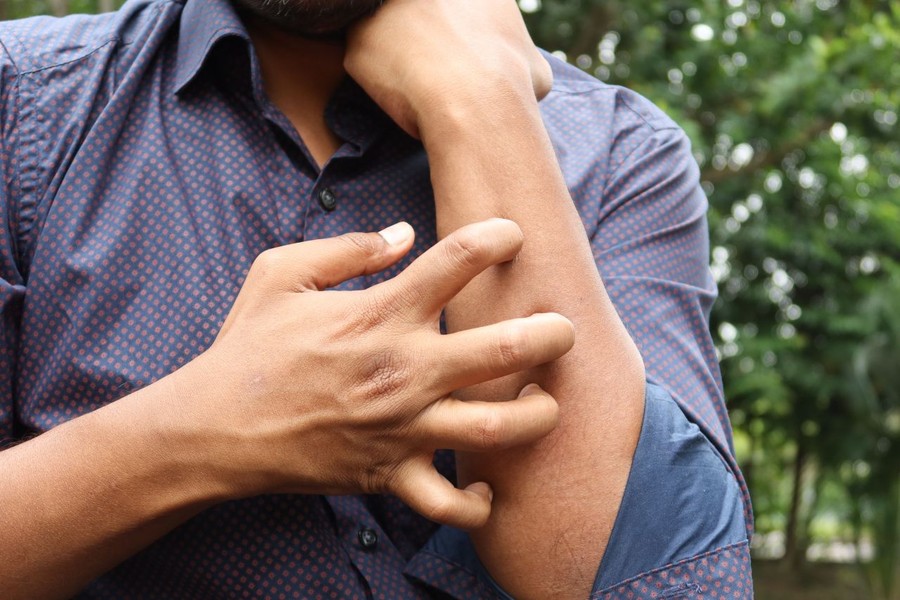 Studio Novartis, l’orticaria cronica spontanea costa 4.200 euro l’anno a paziente Studio Novartis, l’orticaria cronica spontanea costa 4.200 euro l’anno a paziente
