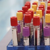 Botulino, dal 2001 al 2024 segnalati 1.276 casi in Italia